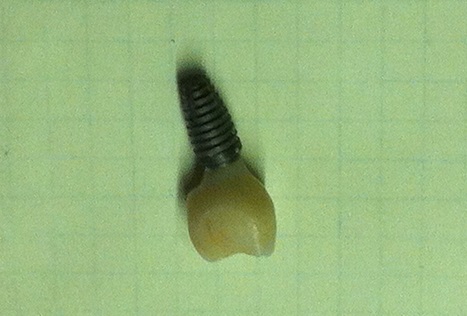 Name:  Dental implant failure.jpg
Views: 719
Size:  49.2 KB